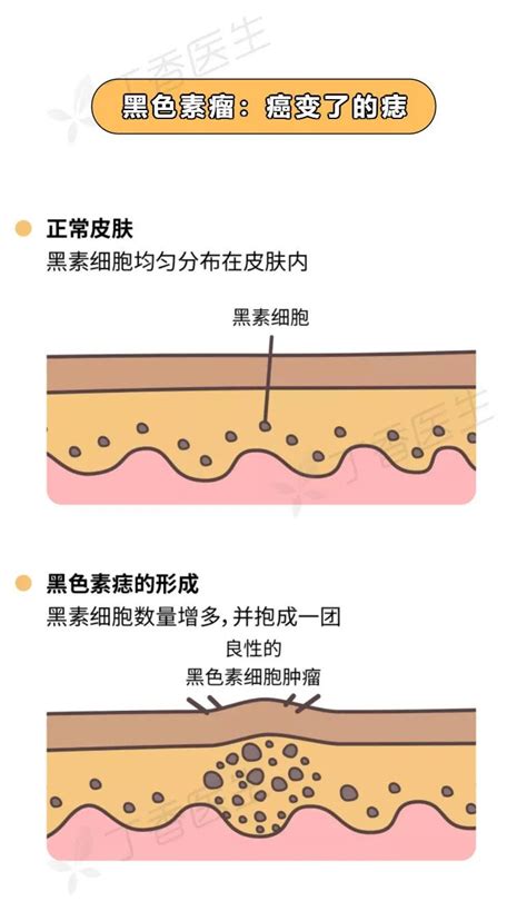 腰上长痣|痣也可能会癌变！长在 3 个地方要注意